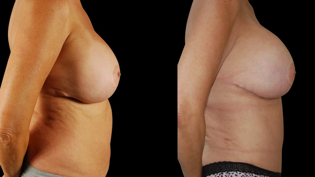 Breast Augmentation Before & After Gallery - Patient 276109 - Image 5