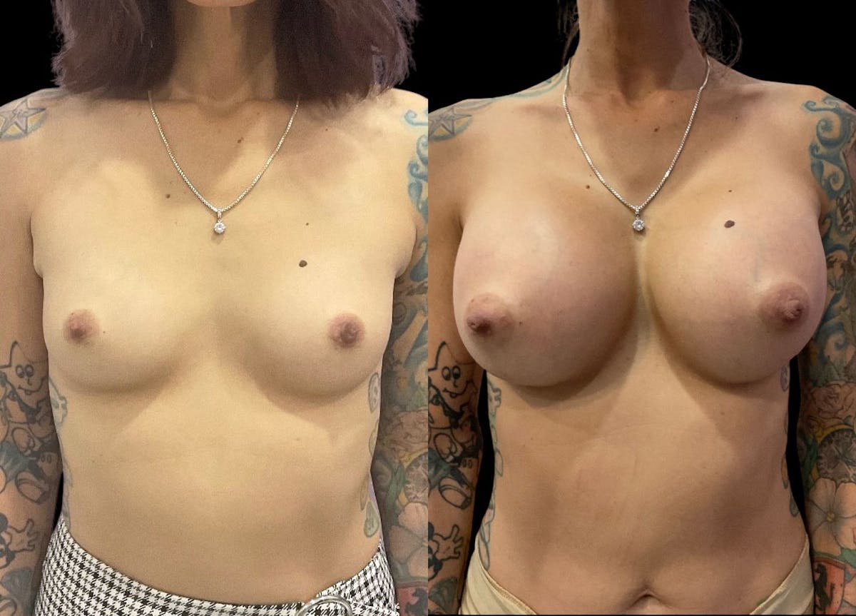 Breast Augmentation Before & After Gallery - Patient 350671 - Image 1