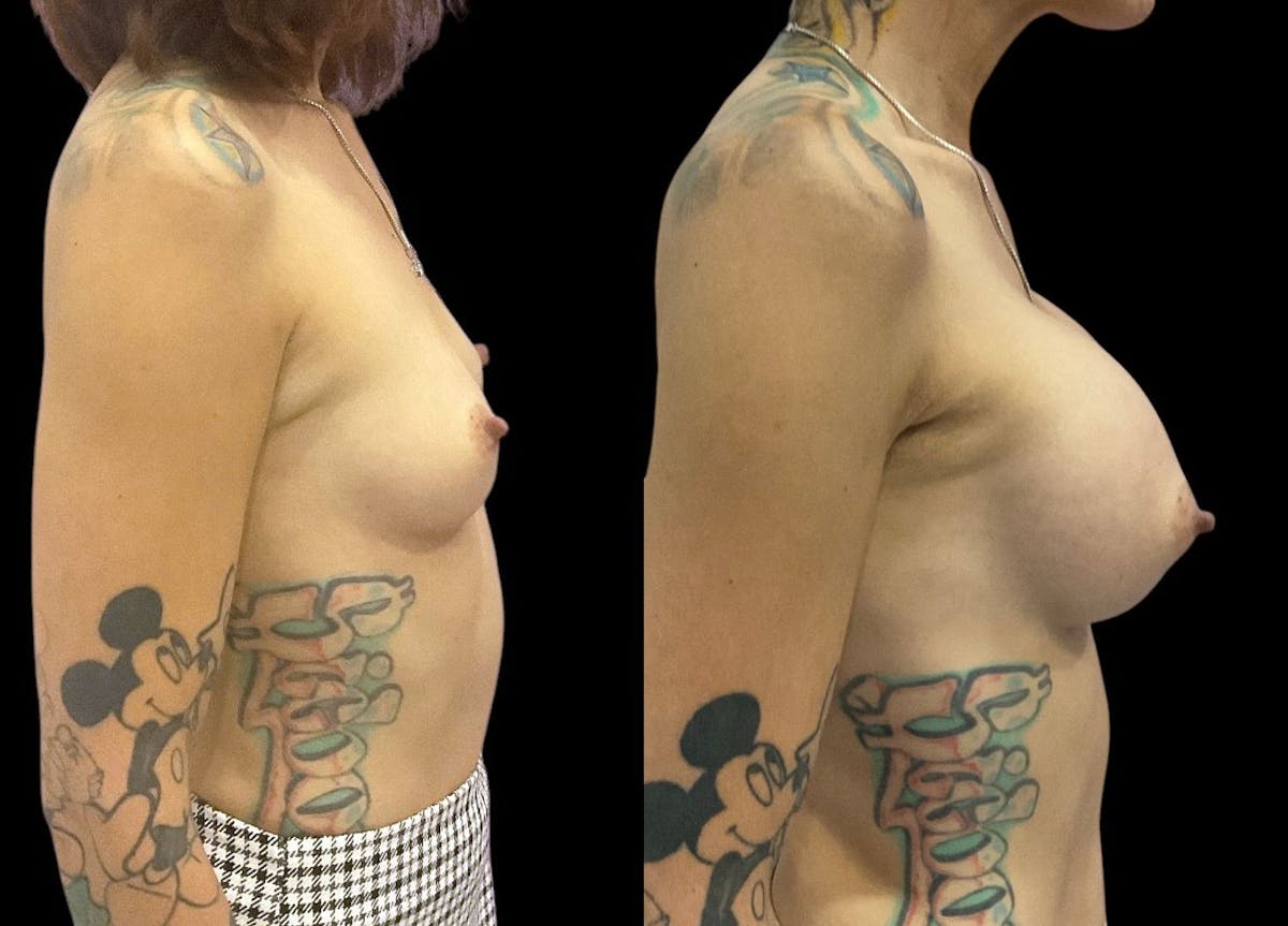 Breast Augmentation Before & After Gallery - Patient 350671 - Image 3