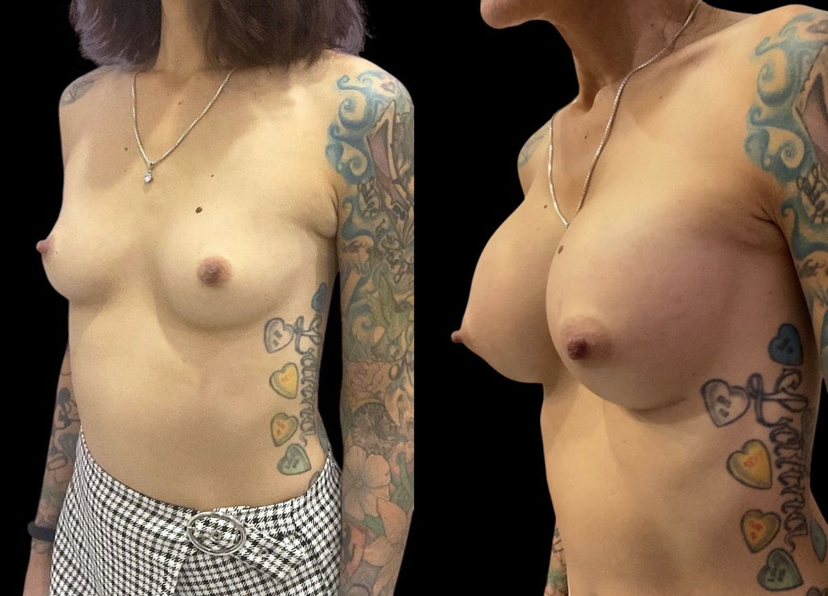 Breast Augmentation Before & After Gallery - Patient 350671 - Image 4