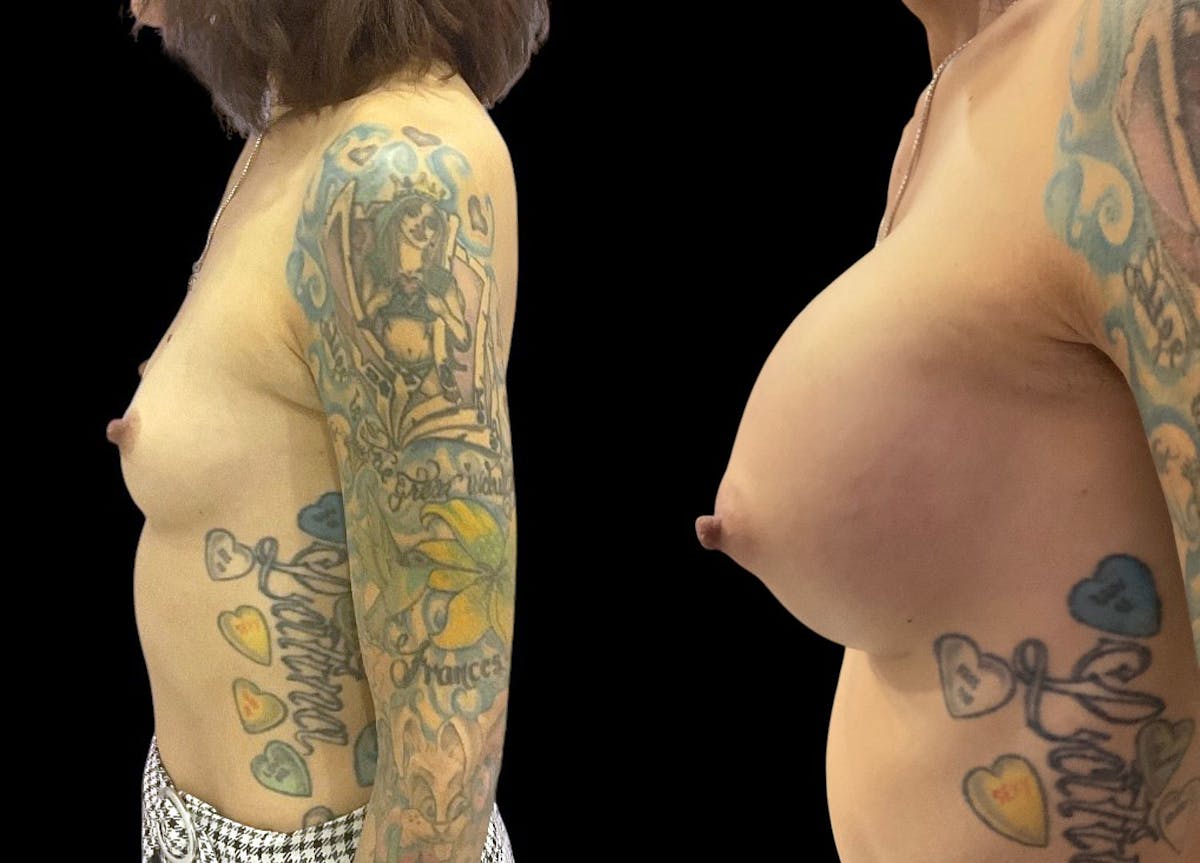 Breast Augmentation Before & After Gallery - Patient 350671 - Image 5