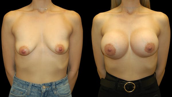 Breast Augmentation Before & After Gallery - Patient 337920 - Image 1