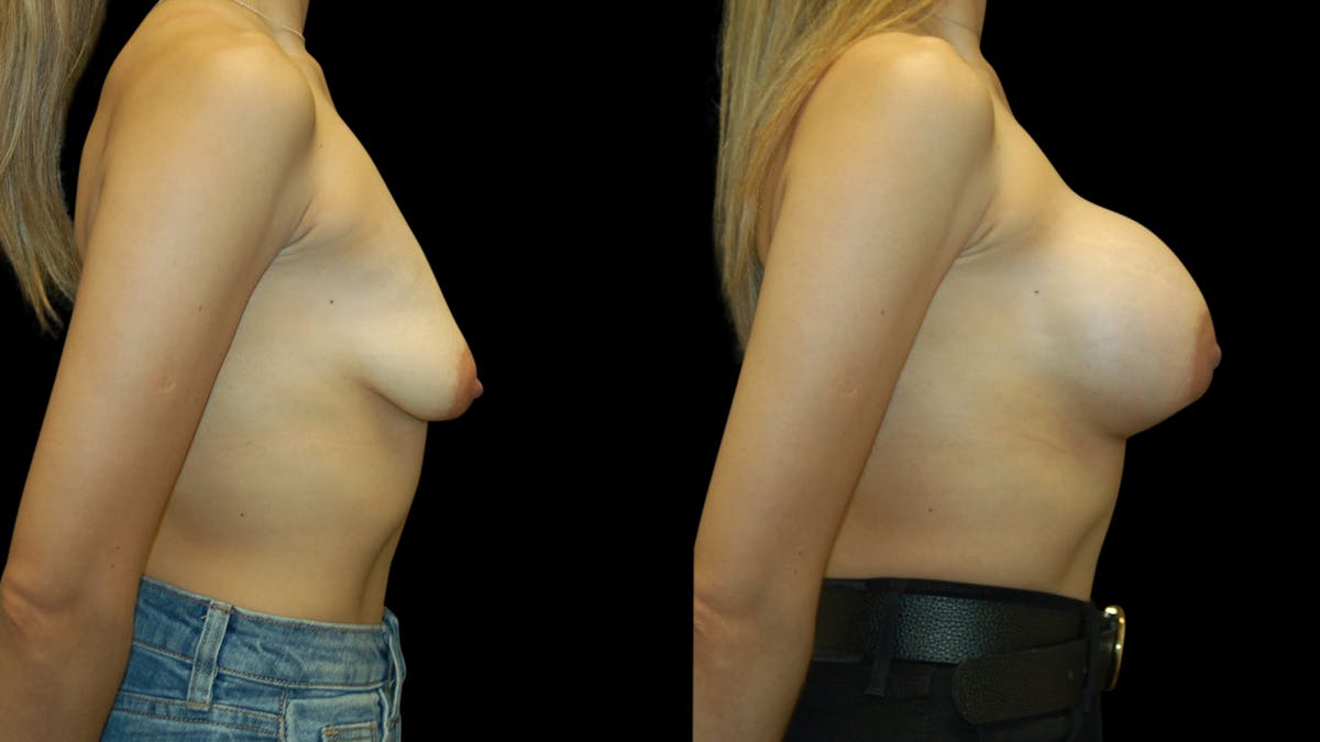 Breast Augmentation Before & After Gallery - Patient 337920 - Image 3