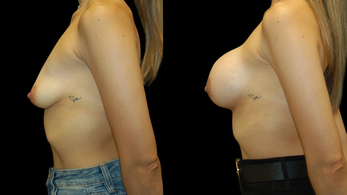 Breast Augmentation Before & After Gallery - Patient 337920 - Image 5