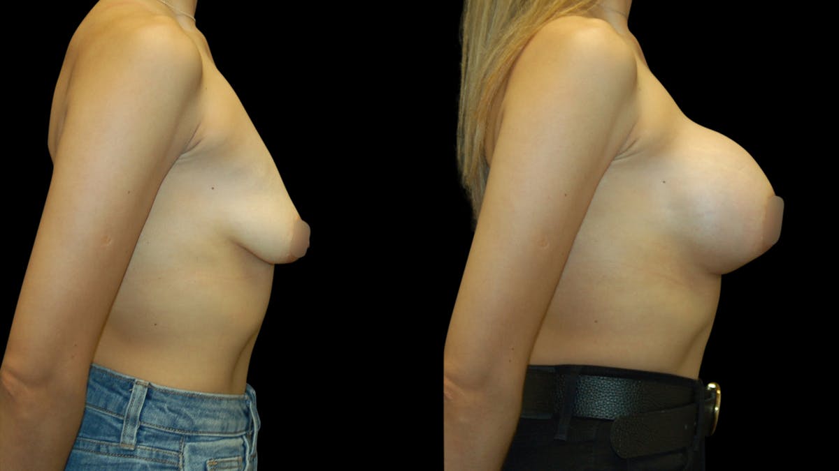 Breast Augmentation Before & After Gallery - Patient 337920 - Image 8