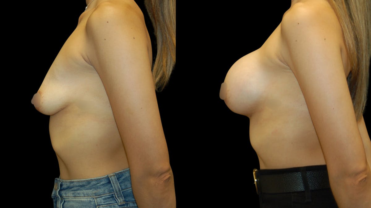 Breast Augmentation Before & After Gallery - Patient 337920 - Image 10