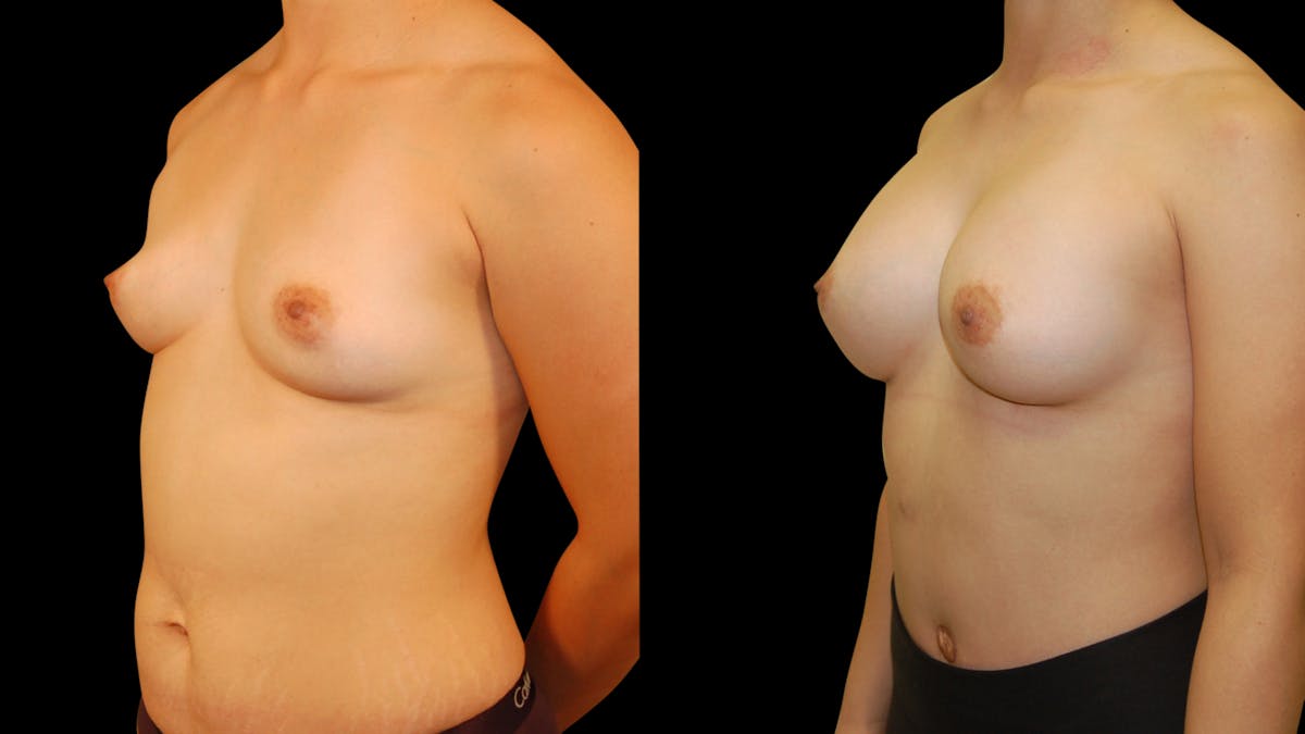 Breast Augmentation Before & After Gallery - Patient 309176 - Image 2