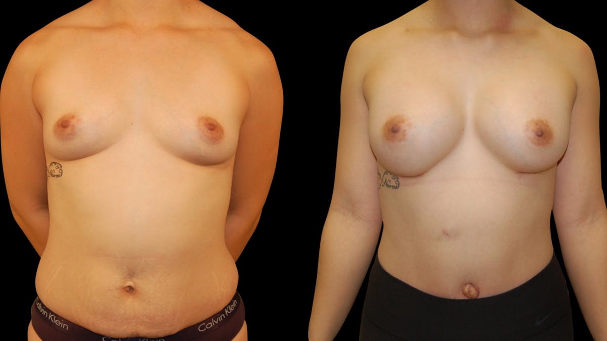 Breast Augmentation Before & After Gallery - Patient 309176 - Image 1