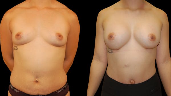 Breast Augmentation Before & After Gallery - Patient 309176 - Image 1
