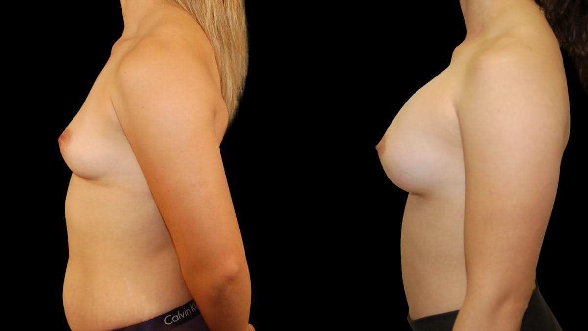 Breast Augmentation Before & After Gallery - Patient 309176 - Image 3