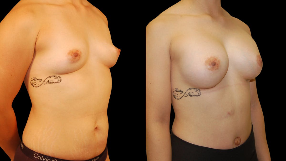 Breast Augmentation Before & After Gallery - Patient 309176 - Image 4