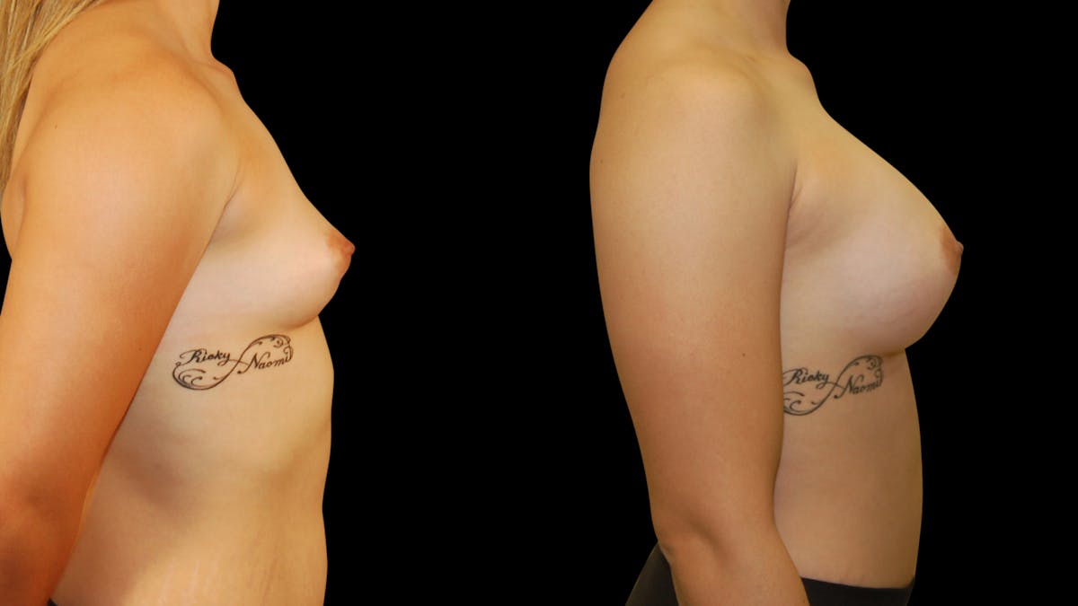Breast Augmentation Before & After Gallery - Patient 309176 - Image 5