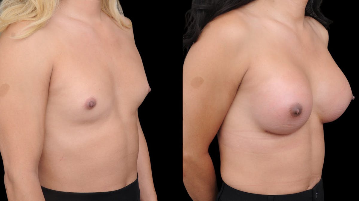 Breast Augmentation Before & After Gallery - Patient 371579 - Image 4