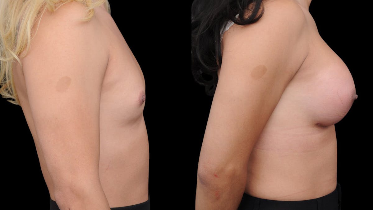 Breast Augmentation Before & After Gallery - Patient 371579 - Image 5