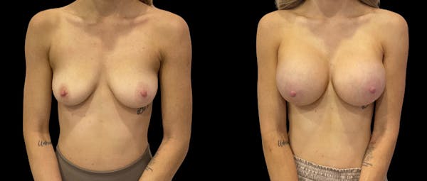Breast Augmentation Before & After Gallery - Patient 310587 - Image 1