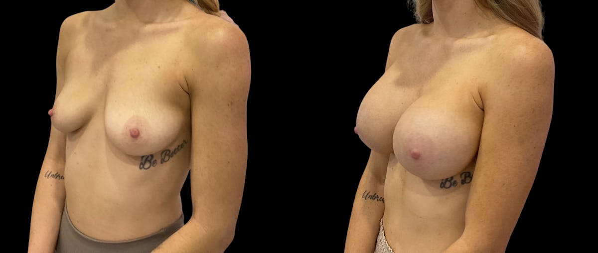 Breast Augmentation Before & After Gallery - Patient 310587 - Image 2