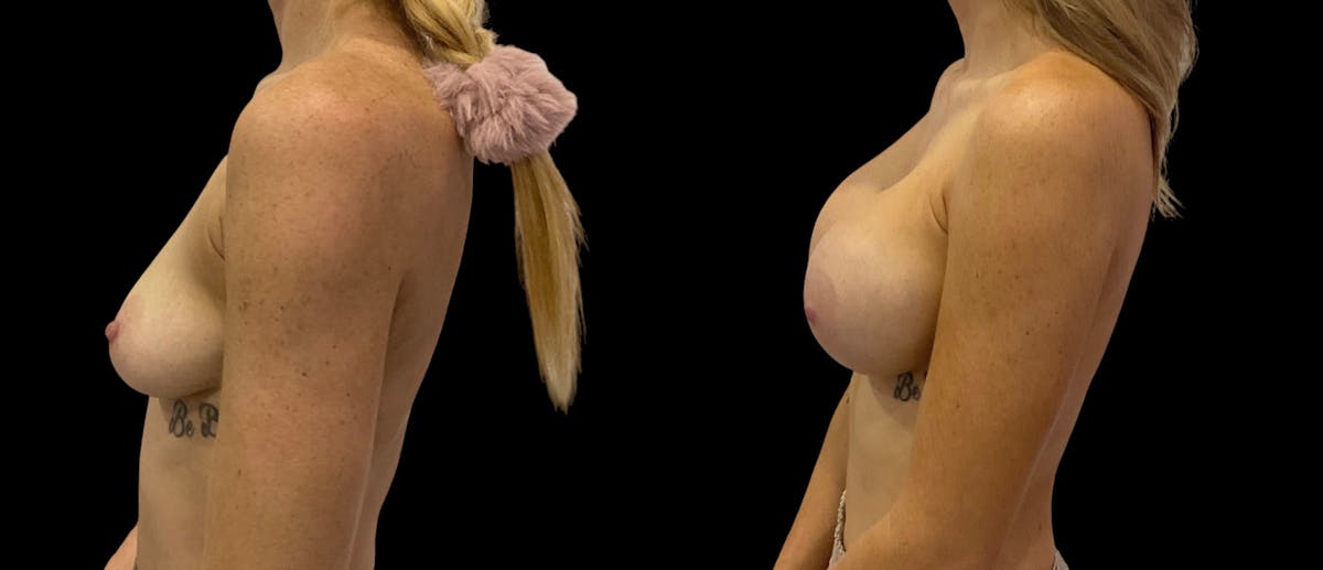 Breast Augmentation Before & After Gallery - Patient 310587 - Image 3