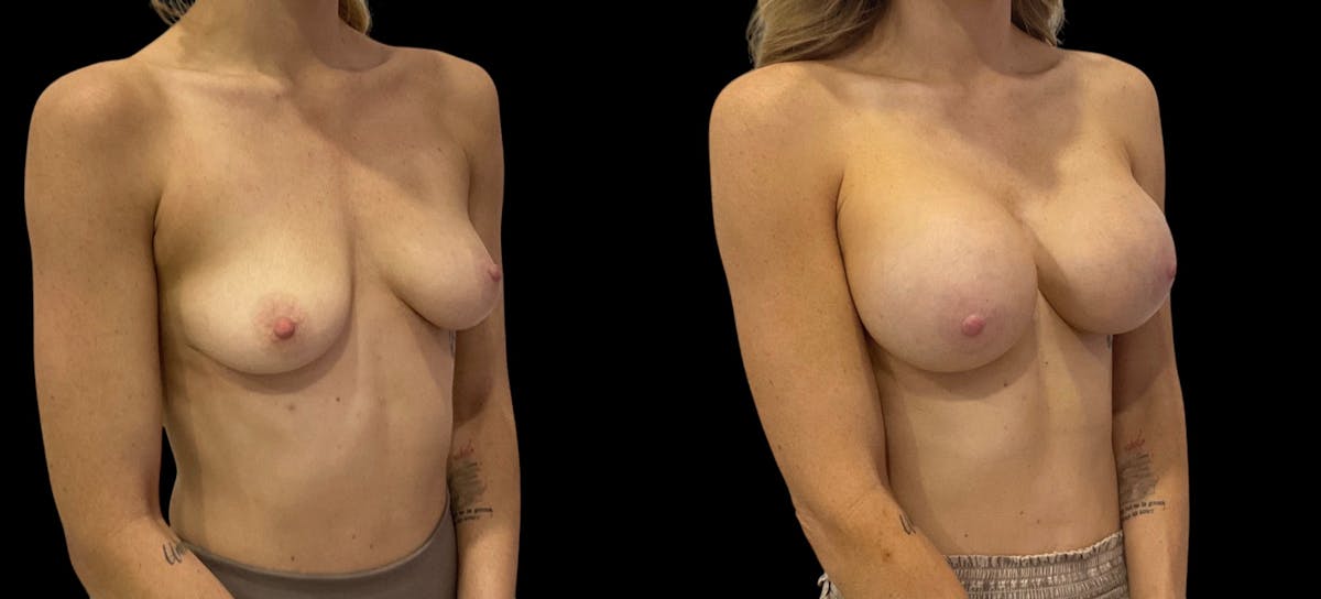 Breast Augmentation Before & After Gallery - Patient 310587 - Image 5