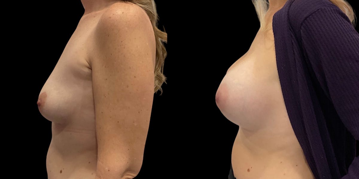 Breast Augmentation Before & After Gallery - Patient 343284 - Image 2