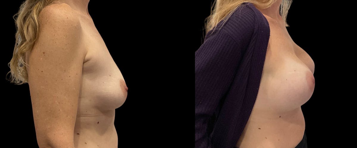 Breast Augmentation Before & After Gallery - Patient 343284 - Image 3