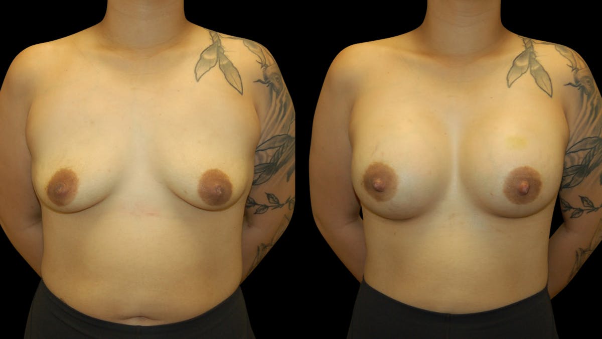 Breast Augmentation Before & After Gallery - Patient 426791 - Image 1