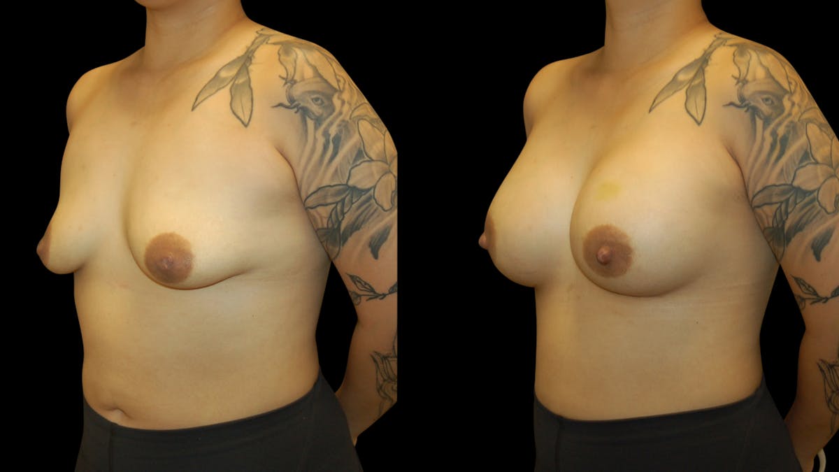 Breast Augmentation Before & After Gallery - Patient 426791 - Image 2