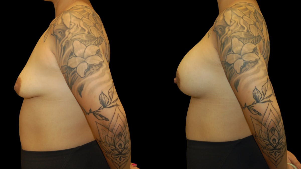 Breast Augmentation Before & After Gallery - Patient 426791 - Image 3