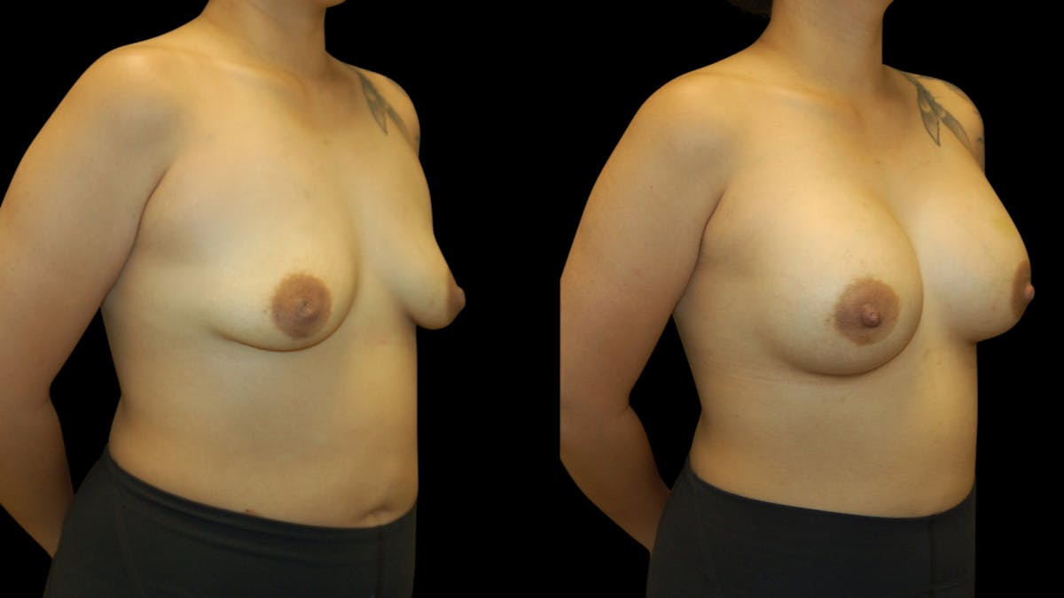 Breast Augmentation Before & After Gallery - Patient 426791 - Image 4