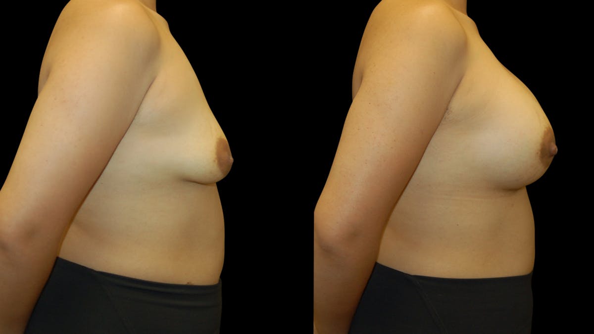 Breast Augmentation Before & After Gallery - Patient 426791 - Image 5