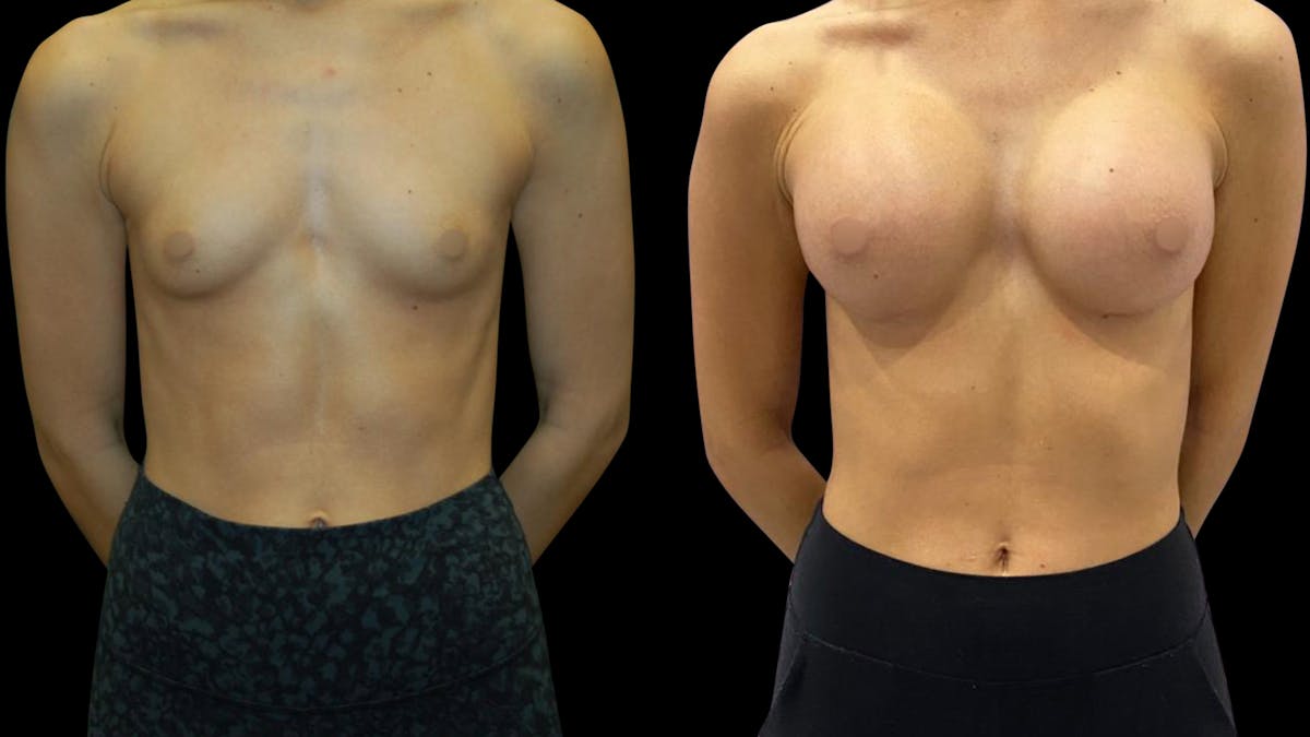 Breast Augmentation Before & After Gallery - Patient 320331 - Image 1