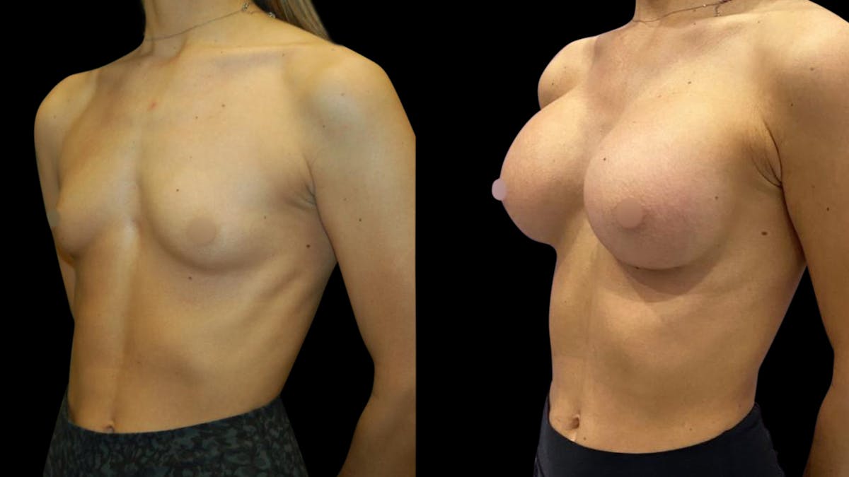 Breast Augmentation Before & After Gallery - Patient 320331 - Image 2