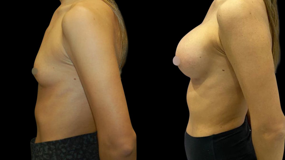 Breast Augmentation Before & After Gallery - Patient 320331 - Image 3