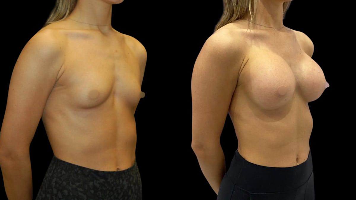 Breast Augmentation Before & After Gallery - Patient 320331 - Image 4