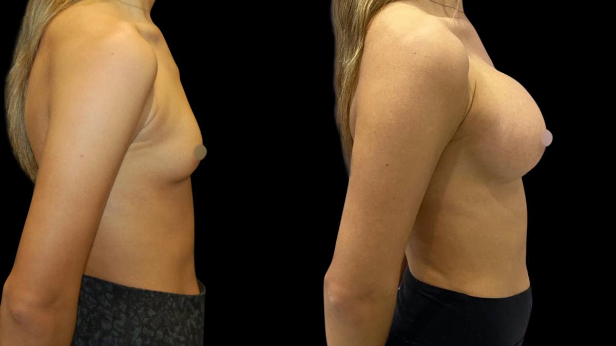 Breast Augmentation Before & After Gallery - Patient 320331 - Image 5