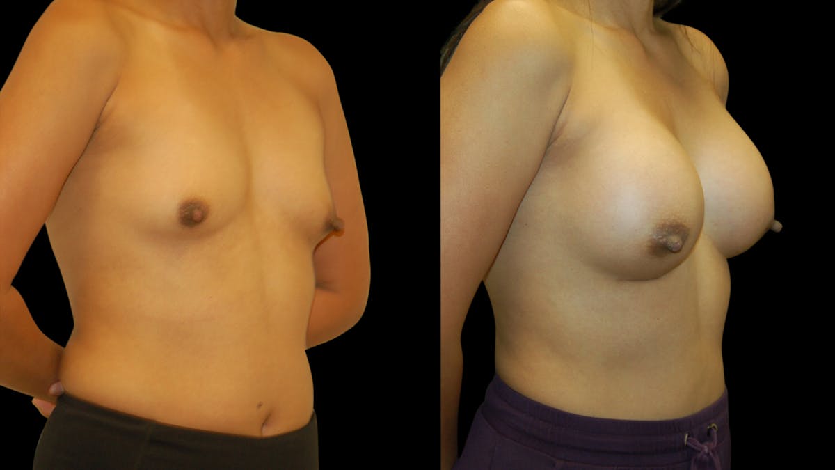 Breast Augmentation Before & After Gallery - Patient 950354 - Image 2