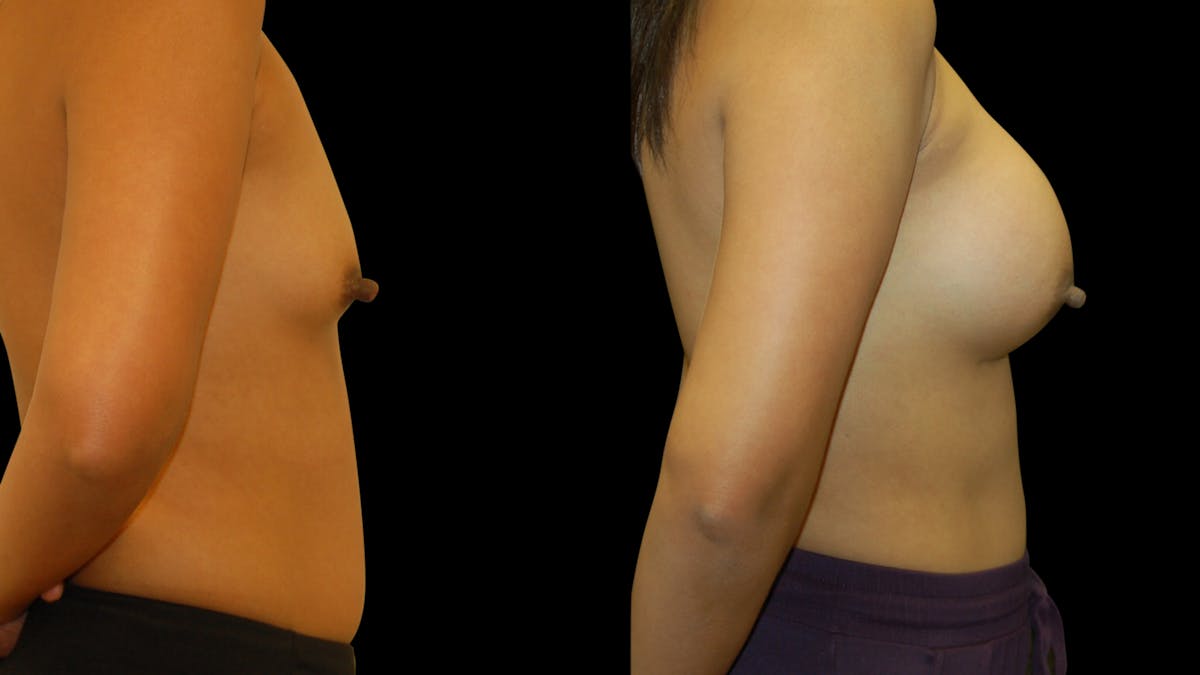 Breast Augmentation Before & After Gallery - Patient 950354 - Image 3