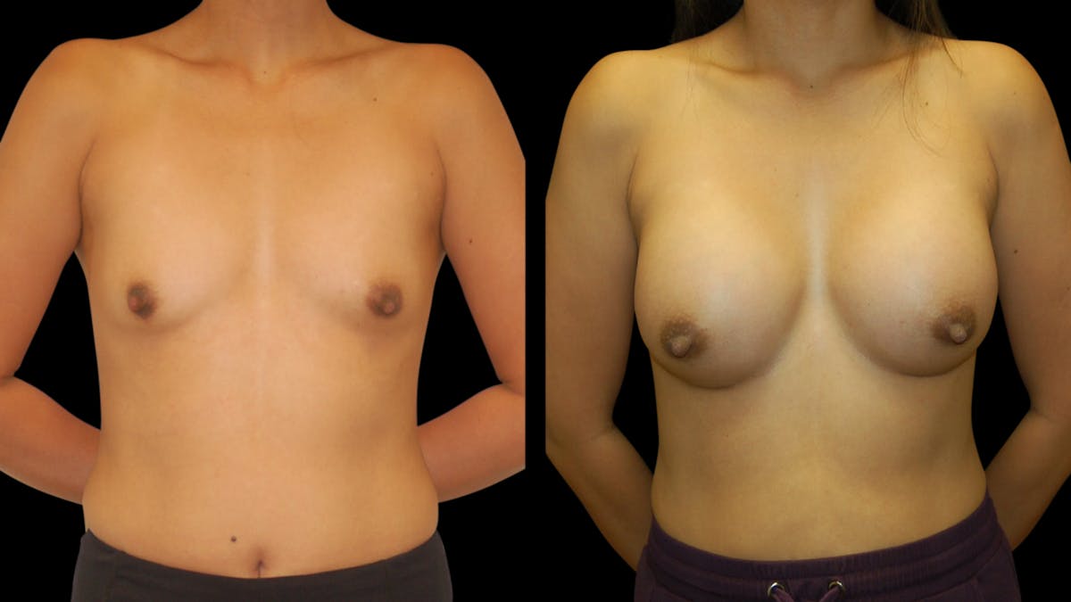 Breast Augmentation Before & After Gallery - Patient 950354 - Image 1