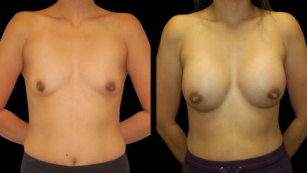 Breast Augmentation Before & After Gallery - Patient 950354 - Image 1