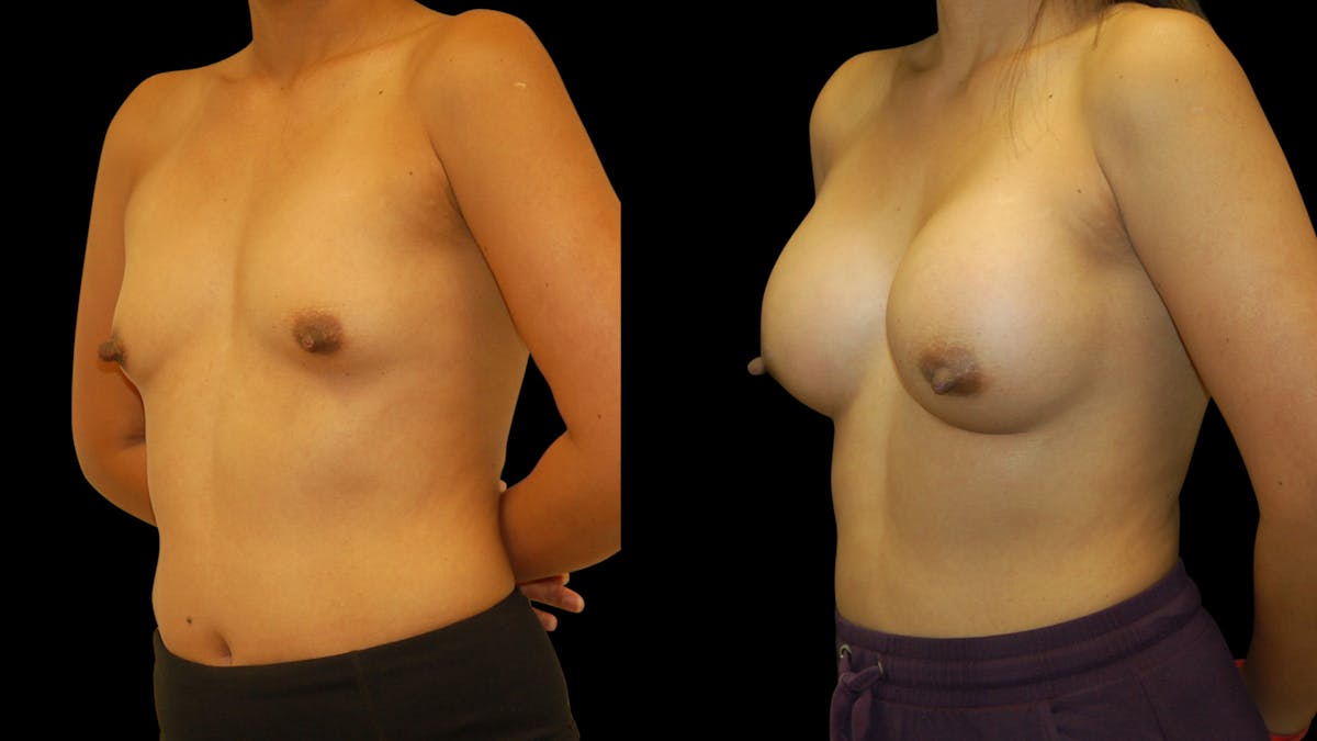 Breast Augmentation Before & After Gallery - Patient 950354 - Image 4