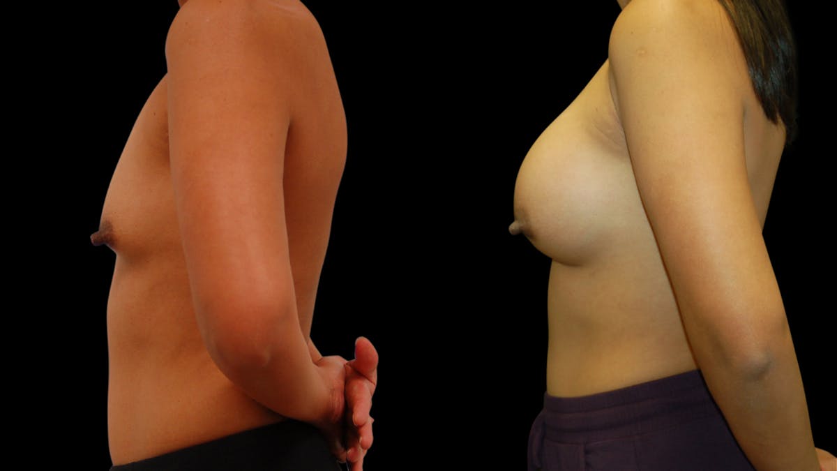 Breast Augmentation Before & After Gallery - Patient 950354 - Image 5