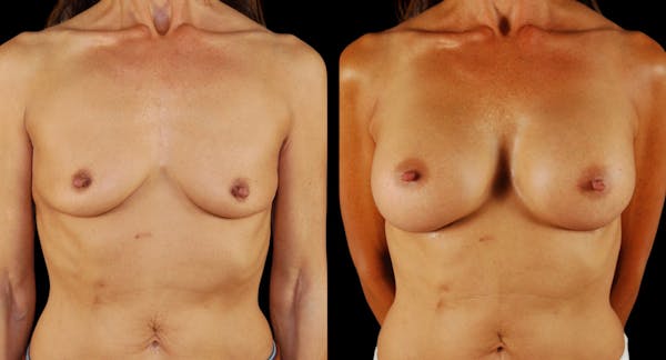 Breast Augmentation Before & After Gallery - Patient 133394 - Image 1