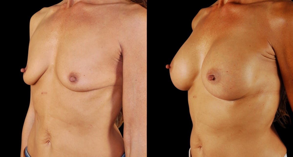 Breast Augmentation Before & After Gallery - Patient 133394 - Image 2