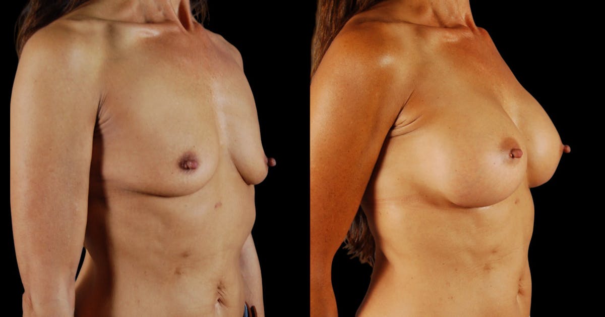 Breast Augmentation Before & After Gallery - Patient 133394 - Image 3