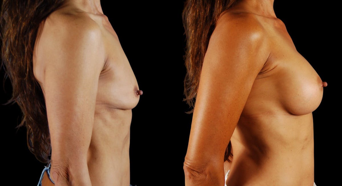 Breast Augmentation Before & After Gallery - Patient 133394 - Image 4