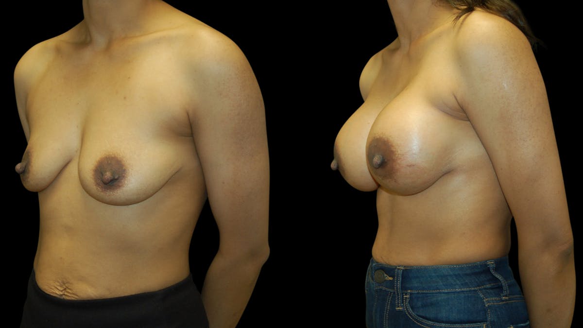 Breast Augmentation Before & After Gallery - Patient 393761 - Image 2