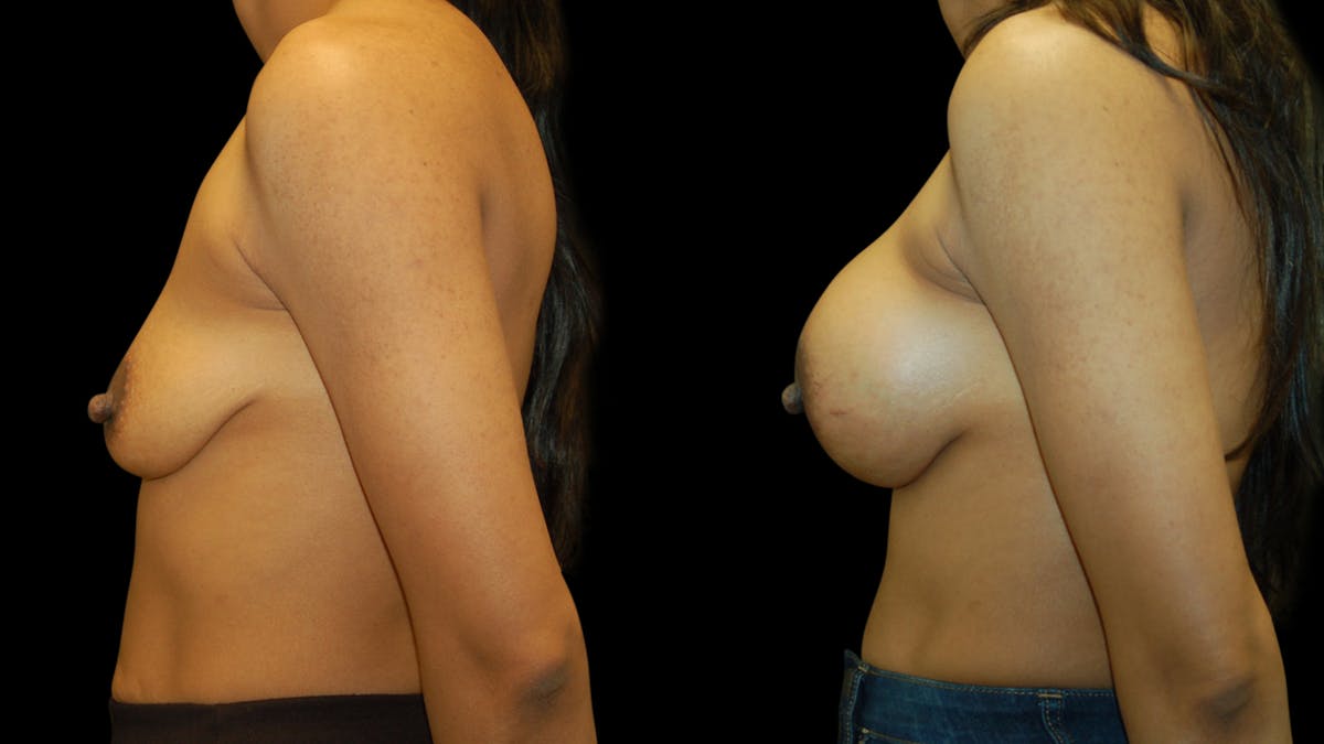 Breast Augmentation Before & After Gallery - Patient 393761 - Image 3