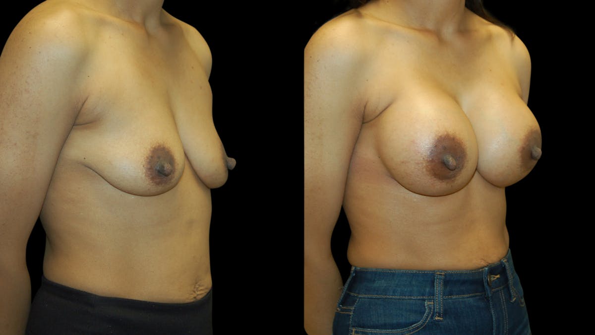 Breast Augmentation Before & After Gallery - Patient 393761 - Image 4