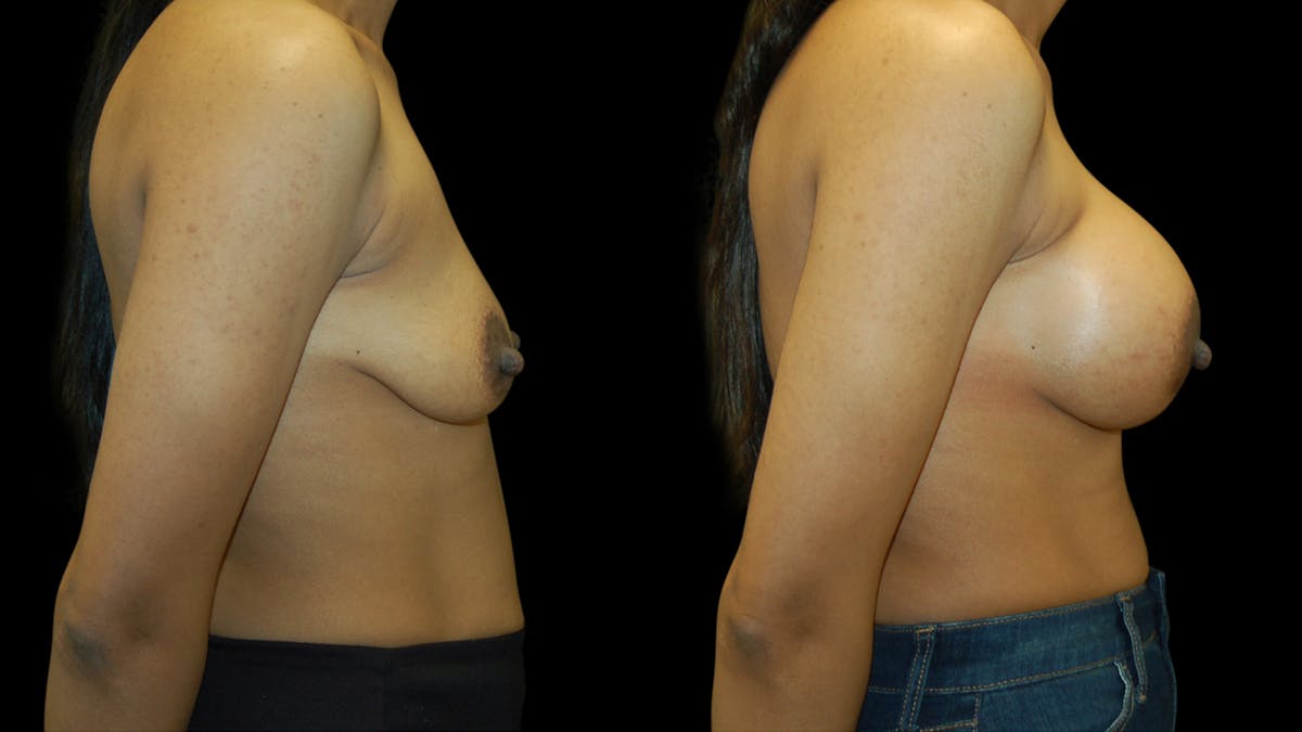 Breast Augmentation Before & After Gallery - Patient 393761 - Image 5