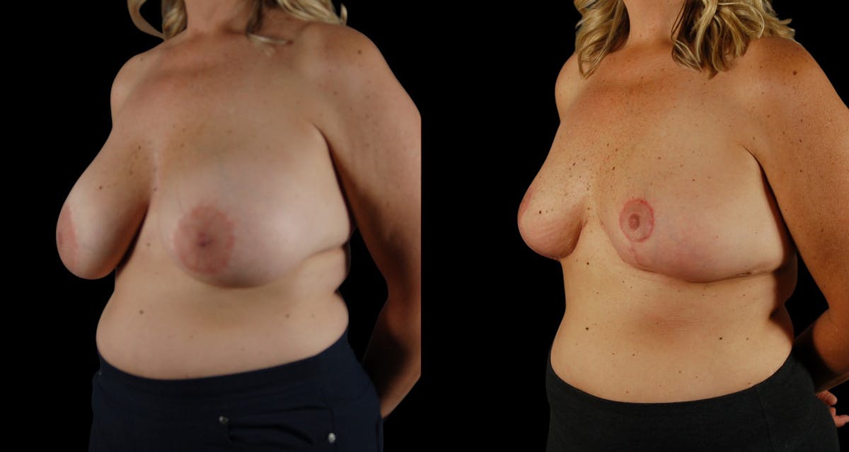 Breast Implant Removal Before & After Gallery - Patient 158908 - Image 3