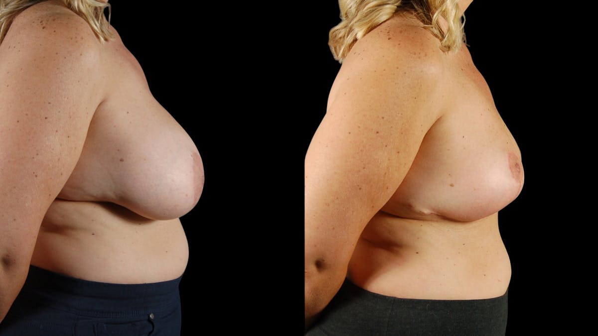 Breast Implant Removal Before & After Gallery - Patient 158908 - Image 4
